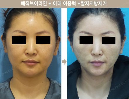 매직브이라인 + 아래 이중턱 + 팔자지방제거