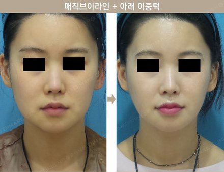 매직브이라인 + 아래 이중턱