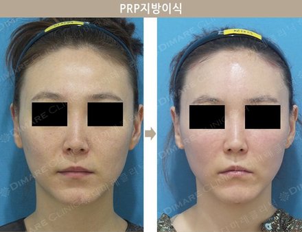 PRP지방이식