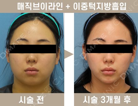 매직브이라인 + 이중턱 지방흡입
