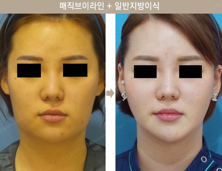 매직브이라인 + 원데이지방이식