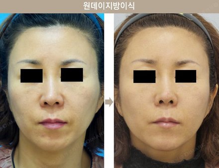 원데이지방이식