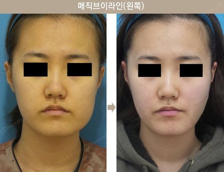 매직브이라인(왼쪽)