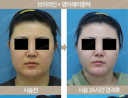 브이라인 + 옆아래이중턱