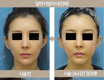 얼굴 전체 지방이식