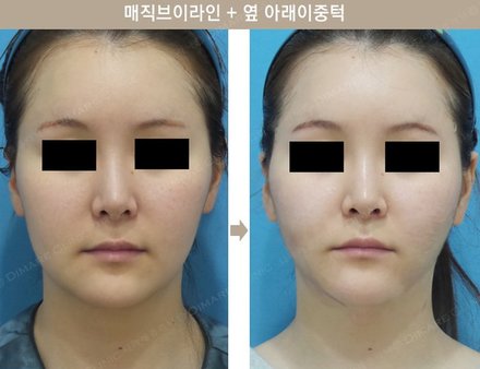 매직브이라인 + 옆 아래 이중턱