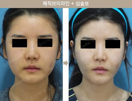 매직브이라인 + 심술보