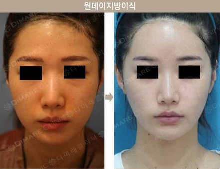 원데이지방이식