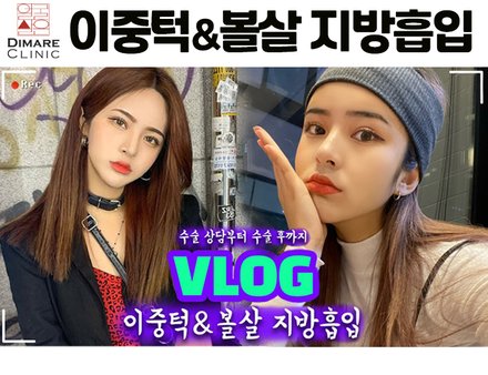 [디마레 리얼스토리] 이중턱, 볼살 지방흡입 3개월까지 후기