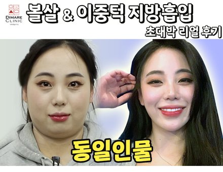 얼굴지방흡입 후 역대급 변화!!!