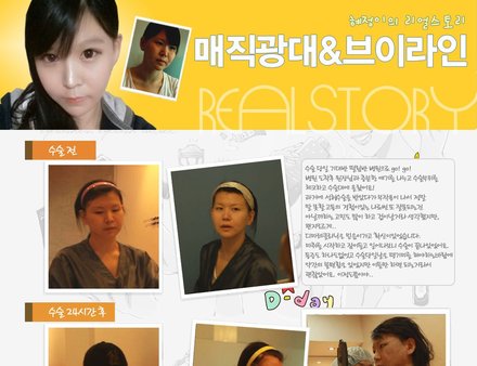 [디마레 리얼스토리] 혜정의 매직광대&매직브이라인 시술기