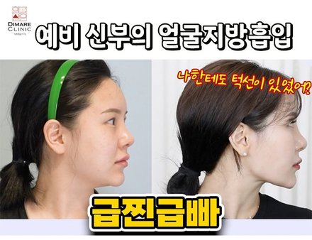 예비 신부의 얼굴지방흡입 리얼스토리