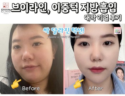 다이어트해도 안빠지던 얼굴살 지방흡입 리얼스토리