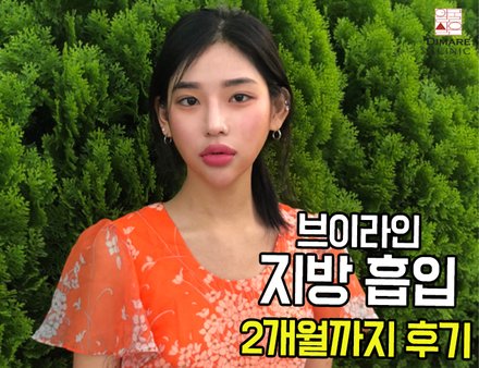  얼굴 비대칭교정을 위한 브이라인 지방흡입 2개월차 리얼 후기