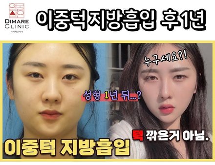 이중턱 지방흡입 1년차 리얼후기