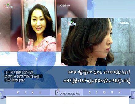 [디마레 리얼스토리] 윤정이의 매직브이라인+DDMR+지방이식