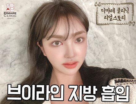 [디마레 리얼스토리] 브이라인 지방흡입 리얼스토리