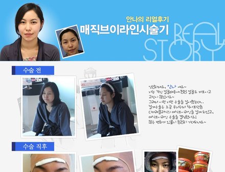 [디마레 리얼스토리] 안나의 매직브이라인 시술기