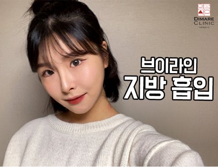 [디마레 리얼스토리] 브이라인 지방흡입 리얼스토리