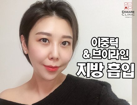 [디마레 리얼스토리] 이중턱 & 브이라인 지방흡입 리얼스토리