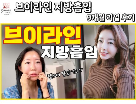 브이라인 지방흡입 9개월까지 리얼 후기