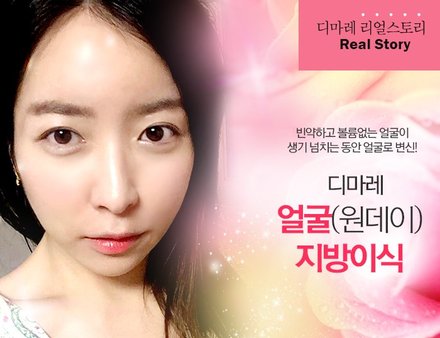 [디마레 리얼스토리] 얼굴(원데이)지방이식 리얼스토리
