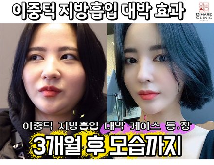 이중턱 지방흡입 3개월까지의 대박 리얼스토리