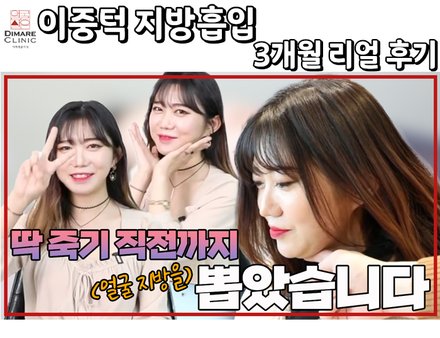 이중턱 지방흡입 3개월 리얼스토리