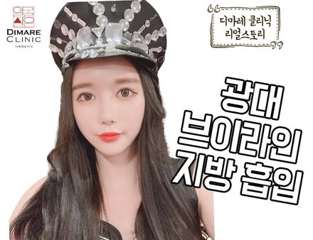 [디마레 리얼스토리] 트랜스젠더의 광대, 브이라인 지방흡입 리얼스토리