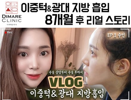 이중턱 & 광대 지방흡입 8개월 리얼 스토리
