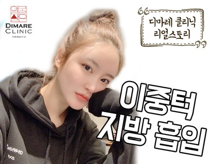 [디마레 리얼스토리] 이중턱 지방흡입 리얼스토리