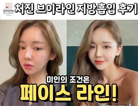 처진 얼굴라인! 지방흡입으로?!