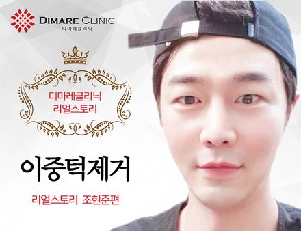 [디마레 리얼스토리] 현준의 이중턱제거 리얼스토리