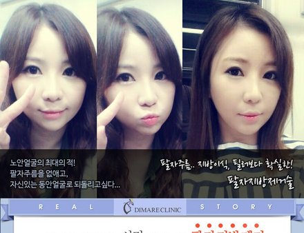 [디마레 리얼스토리] 연수의 팔자지방제거