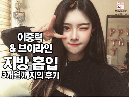 이중턱&브이라인 지방흡입 3개월까지의 리얼스토리