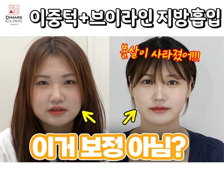 디마레에서 지방흡입했더니 다른 사람이 됐어요