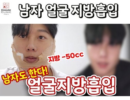 요즘 남자들은 다 하는 얼굴지방흡입 리얼스토리