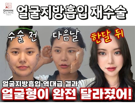 얼굴지흡 재수술도 역시 디마레클리닉