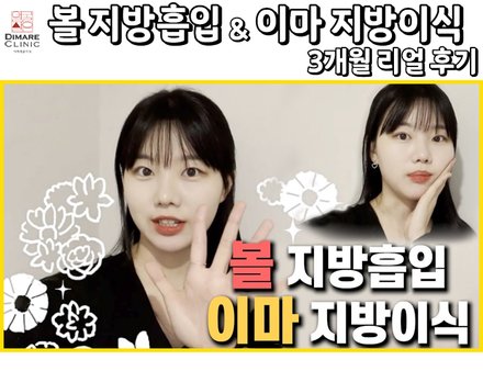 볼 지방흡입&이마 지방이식 3개월 리얼스토리