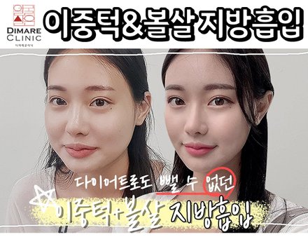 이중턱 볼살 지방흡입하고 여신됐어요