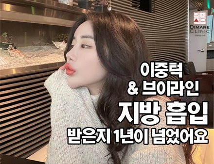 이중턱 & 브이라인 지방흡입 1년차 리얼후기