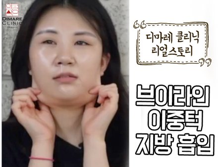 [디마레 리얼스토리] 이중턱/브이라인 지방흡입 리얼스토리