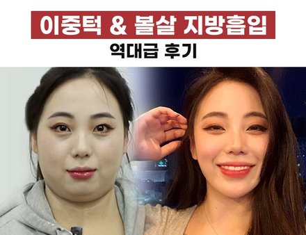 얼굴지방흡입하고 보정어플 삭제한 후기