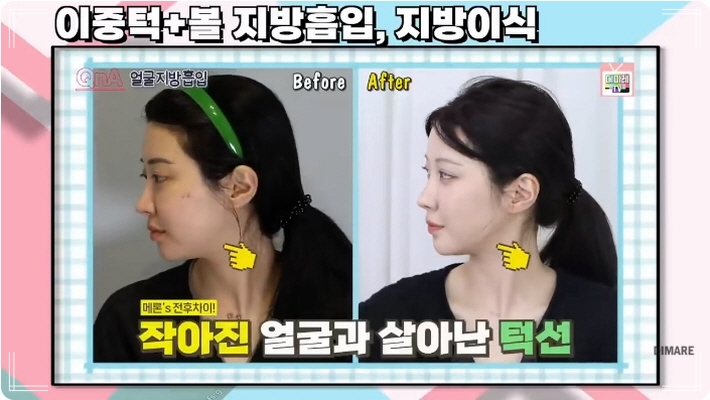 얼굴지방이식후기 디마레클리닉 치료사례