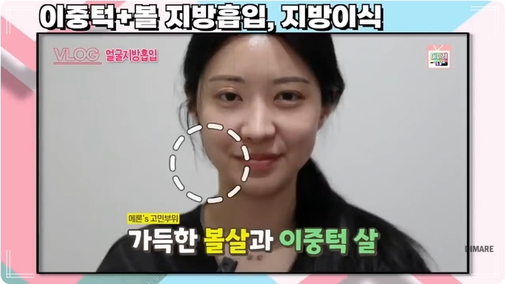 얼굴지방이식후기 디마레클리닉 후기