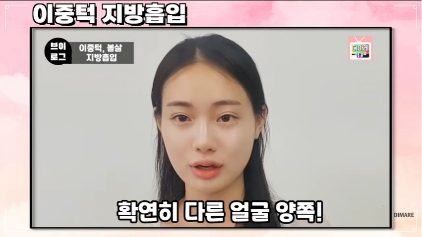 디마레클리닉 마른체형 이중턱 지방흡입 사례