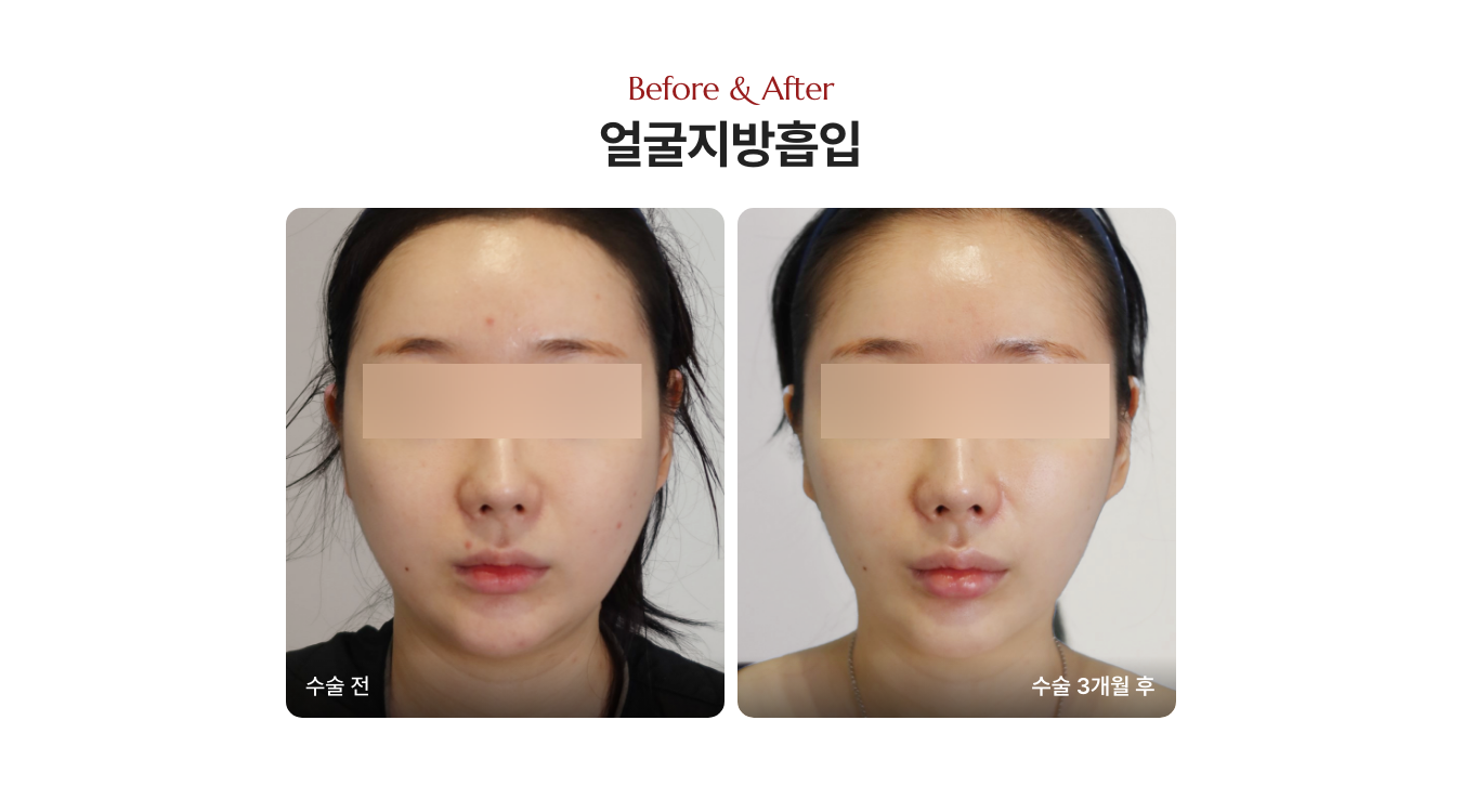 얼굴살빼는법 전후 사진 디마레클리닉