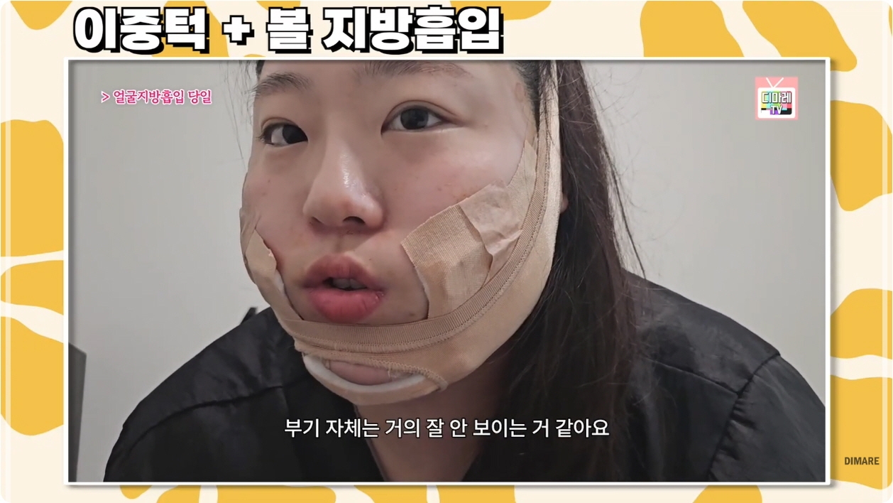 얼굴살빼는시술, 디마레클리닉 디자인 과정