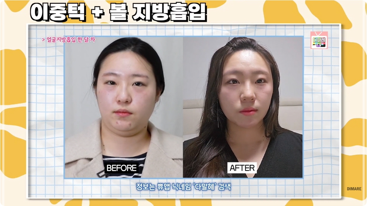 얼굴살빼는시술, 디마레클리닉 치료 결과