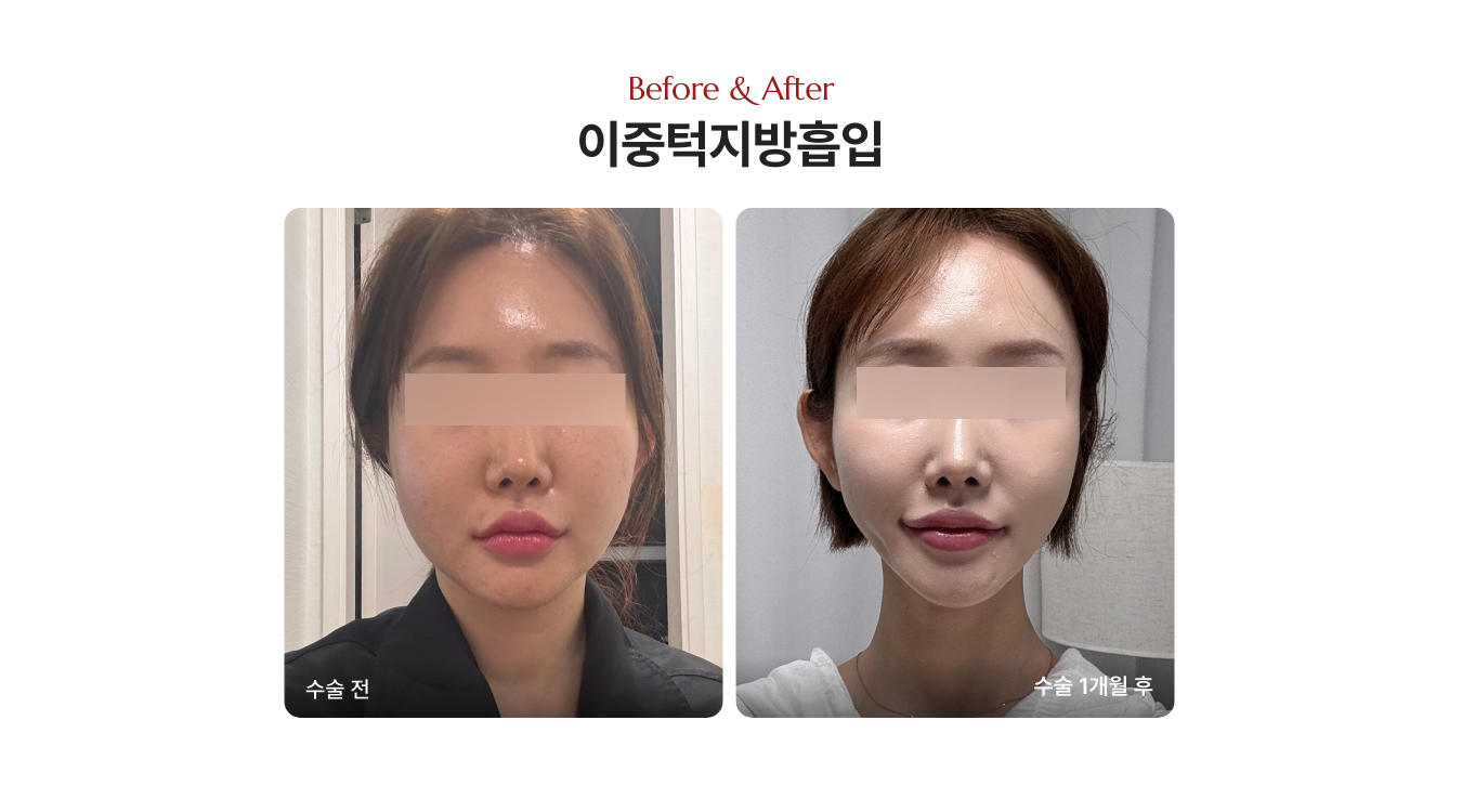 얼굴살 지방흡입 전후 사진